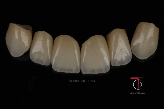 AZR-T MULTI: Revolutionizing Aesthetic Outcomes in Complex Dental Restorations